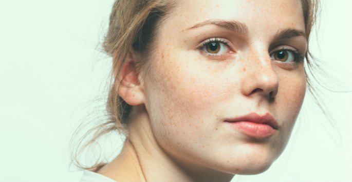 Common Reasons to Seek Acne Treatment