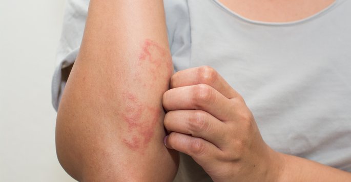 Treating Psoriasis: Things to Consider