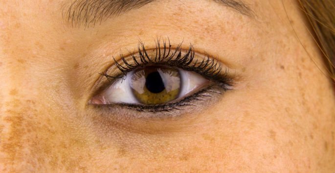Brown Spots and Aging Skin: What is the Correlation?