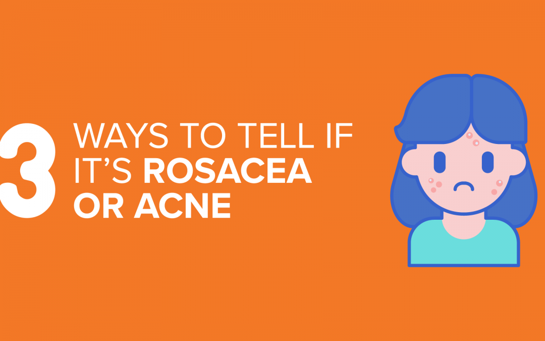 3 Ways To Tell If It’s Rosacea Or Acne