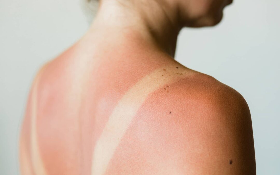 Don’t Be a Sun Goddess This Summer.  Dr. Yeoman’s Dermatology Office Reminds You to Apply Sunscreen.