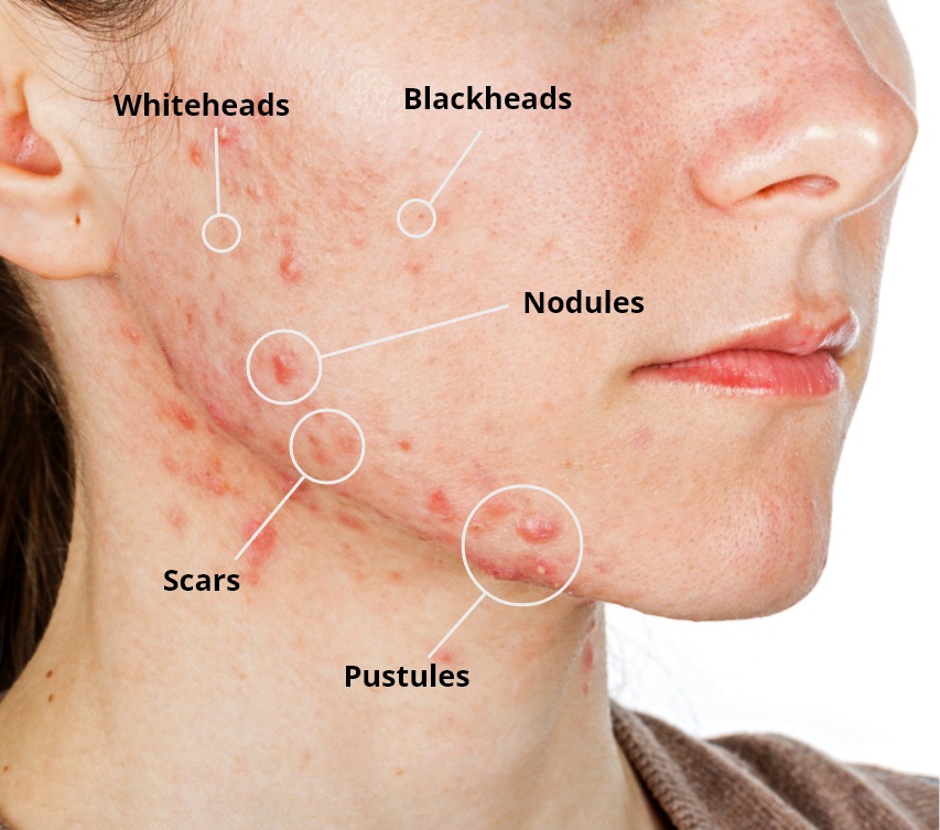 Acne Treatment - The Dermatology Office